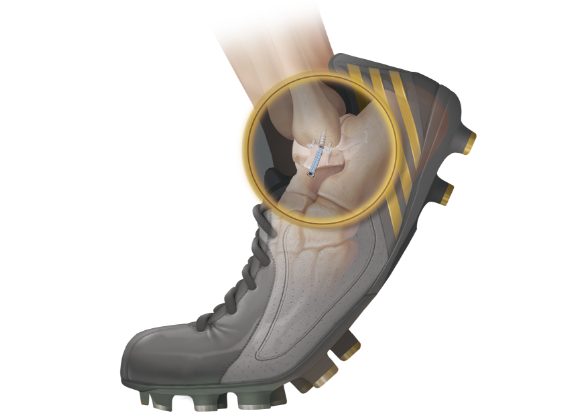 Arthrex - InternalBrace Implant System, Ligament